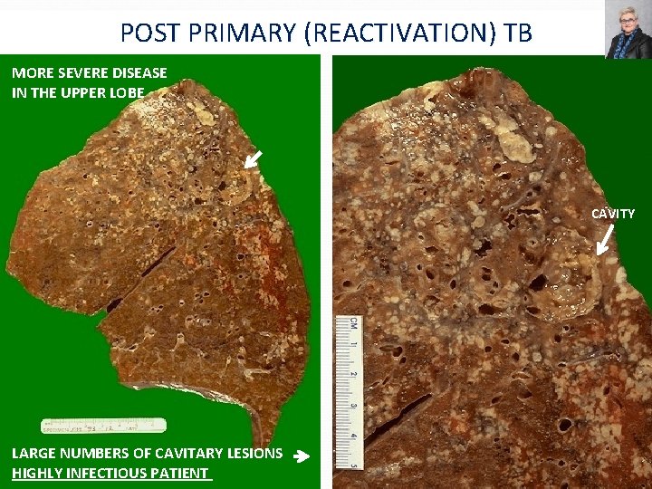 POST PRIMARY (REACTIVATION) TB MORE SEVERE DISEASE IN THE UPPER LOBE CAVITY LARGE NUMBERS