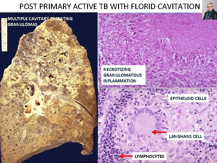 POST PRIMARY ACTIVE TB WITH FLORID CAVITATION MULTIPLE CAVITARY CASEATING GRANULOMAS NECROTIZING GRANULOMATOUS INFLAMMATION