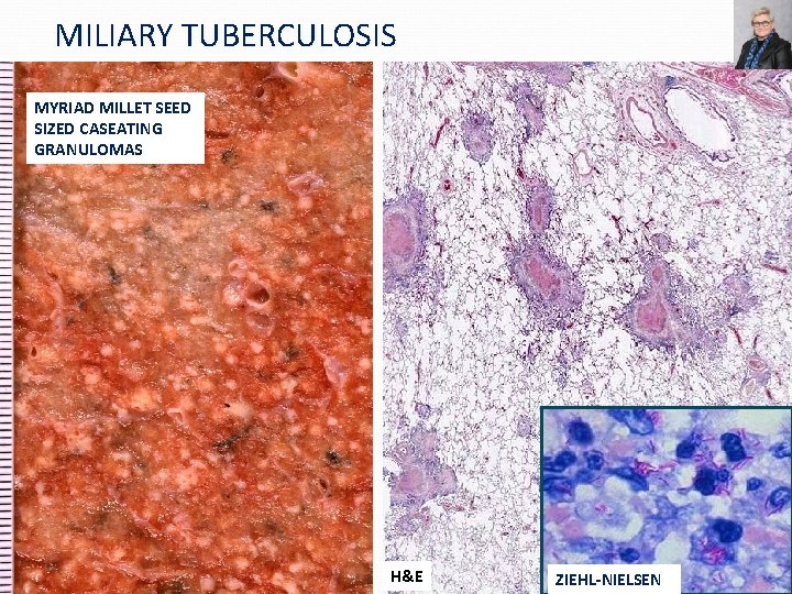 MILIARY TUBERCULOSIS MYRIAD MILLET SEED SIZED CASEATING GRANULOMAS H&E ZIEHL-NIELSEN 