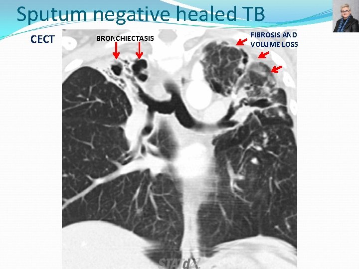 Sputum negative healed TB CECT BRONCHIECTASIS FIBROSIS AND VOLUME LOSS 
