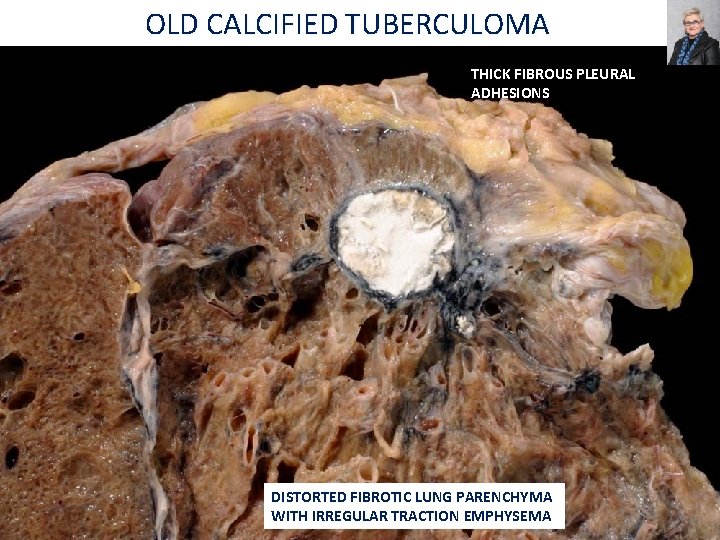 OLD CALCIFIED TUBERCULOMA THICK FIBROUS PLEURAL ADHESIONS DISTORTED FIBROTIC LUNG PARENCHYMA WITH IRREGULAR TRACTION