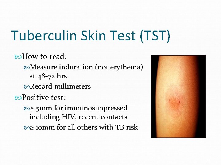 Tuberculin Skin Test (TST) How to read: Measure induration (not erythema) at 48 -72