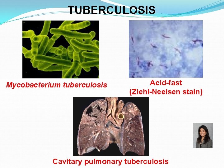 TUBERCULOSIS Mycobacterium tuberculosis Acid-fast (Ziehl-Neelsen stain) Cavitary pulmonary tuberculosis 