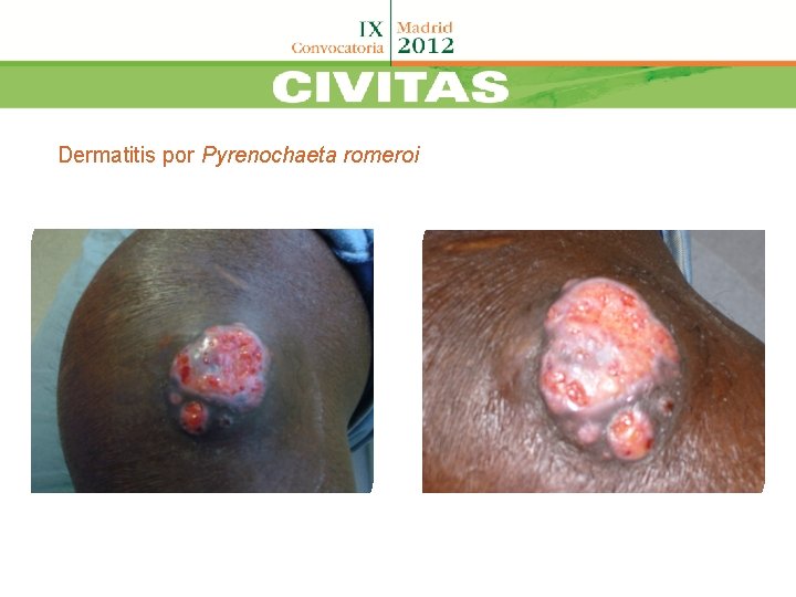 Dermatitis por Pyrenochaeta romeroi 