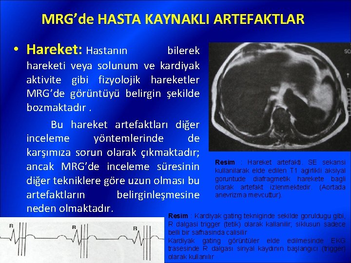 MRG’de HASTA KAYNAKLI ARTEFAKTLAR • Hareket: Hastanın bilerek hareketi veya solunum ve kardiyak aktivite