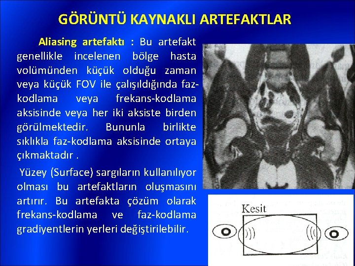 GÖRÜNTÜ KAYNAKLI ARTEFAKTLAR Aliasing artefaktı : Bu artefakt genellikle incelenen bölge hasta volümünden küçük