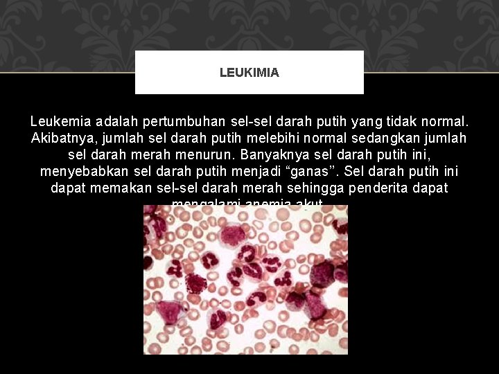 LEUKIMIA Leukemia adalah pertumbuhan sel-sel darah putih yang tidak normal. Akibatnya, jumlah sel darah