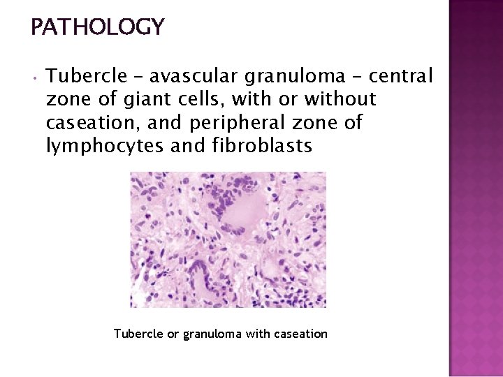 PATHOLOGY • Tubercle – avascular granuloma – central zone of giant cells, with or