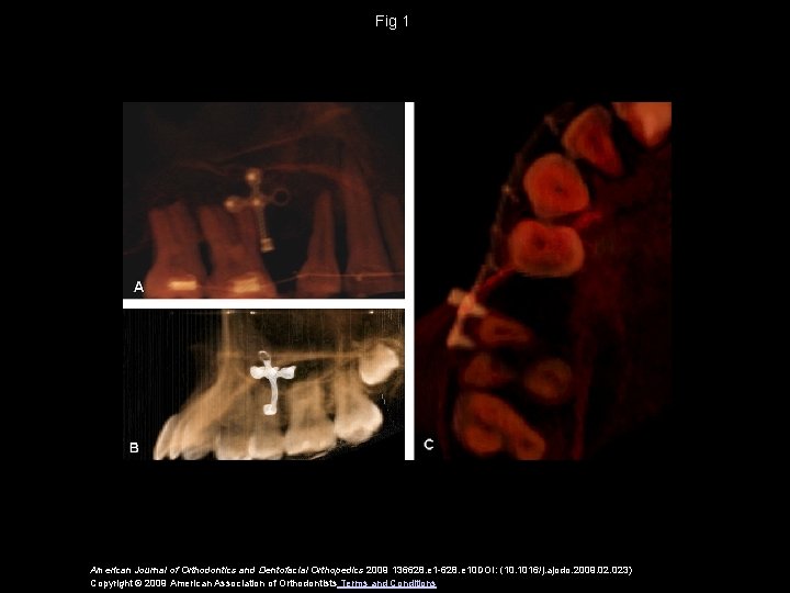 Fig 1 American Journal of Orthodontics and Dentofacial Orthopedics 2009 136628. e 1 -628.