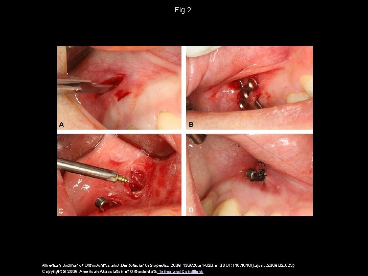 Fig 2 American Journal of Orthodontics and Dentofacial Orthopedics 2009 136628. e 1 -628.