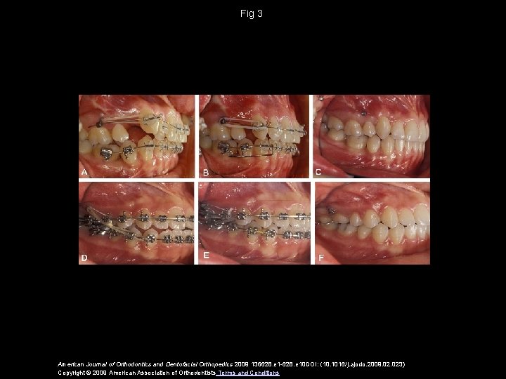 Fig 3 American Journal of Orthodontics and Dentofacial Orthopedics 2009 136628. e 1 -628.