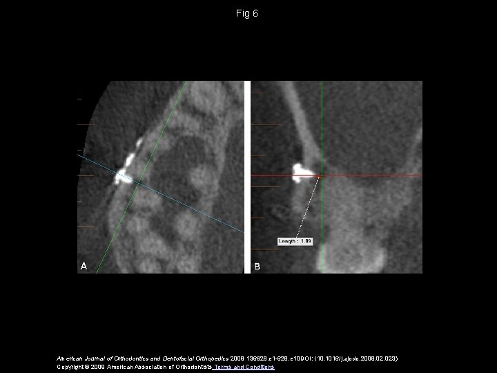 Fig 6 American Journal of Orthodontics and Dentofacial Orthopedics 2009 136628. e 1 -628.