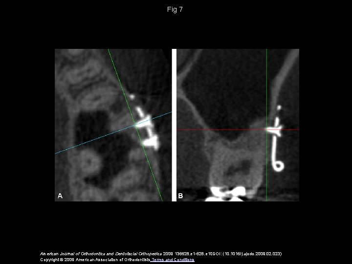 Fig 7 American Journal of Orthodontics and Dentofacial Orthopedics 2009 136628. e 1 -628.