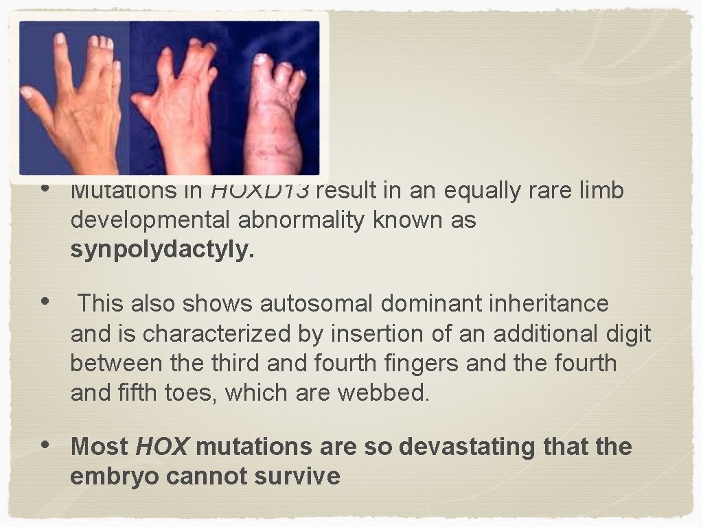  • Mutations in HOXD 13 result in an equally rare limb developmental abnormality