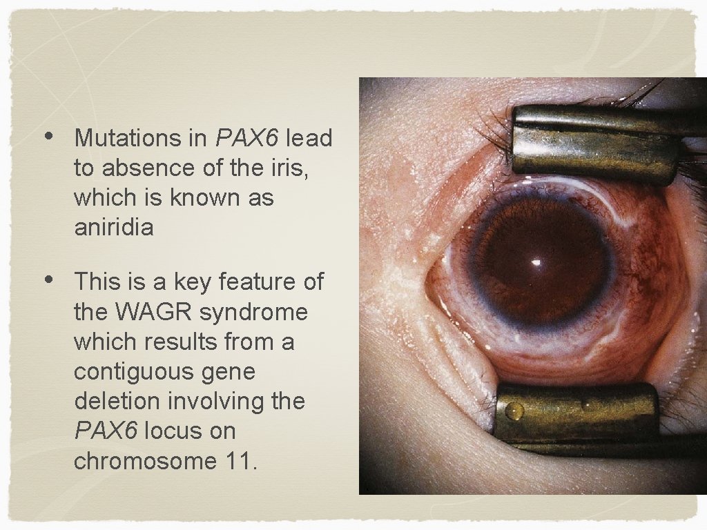  • Mutations in PAX 6 lead to absence of the iris, which is