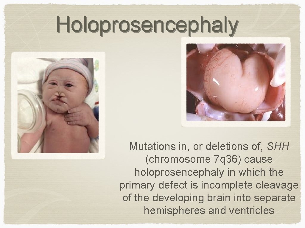 Holoprosencephaly Mutations in, or deletions of, SHH (chromosome 7 q 36) cause holoprosencephaly in