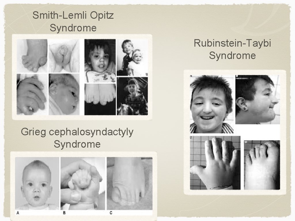 Smith-Lemli Opitz Syndrome Rubinstein-Taybi Syndrome Grieg cephalosyndactyly Syndrome 