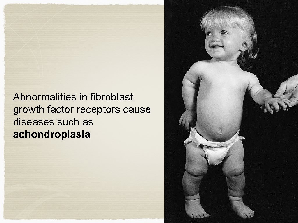 Abnormalities in fibroblast growth factor receptors cause diseases such as achondroplasia 