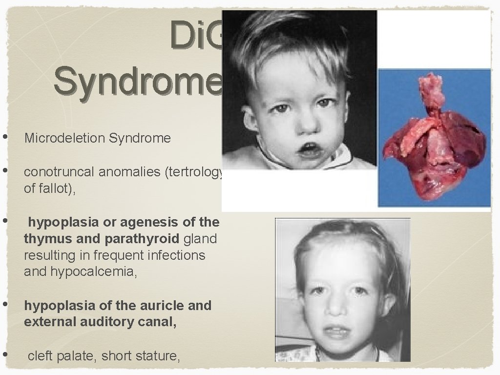 Di. George Syndrome • Microdeletion Syndrome • conotruncal anomalies (tertrology of fallot), • hypoplasia