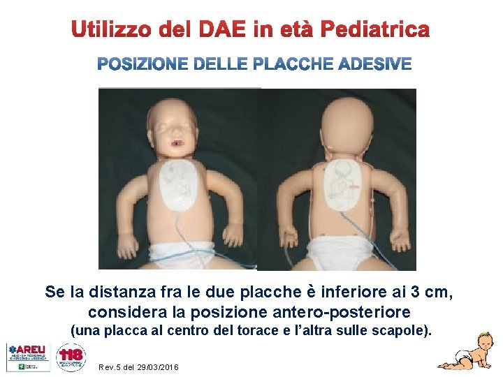 Se la distanza fra le due placche è inferiore ai 3 cm, considera la