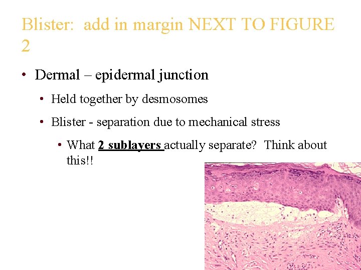 Blister: add in margin NEXT TO FIGURE 2 • Dermal – epidermal junction •