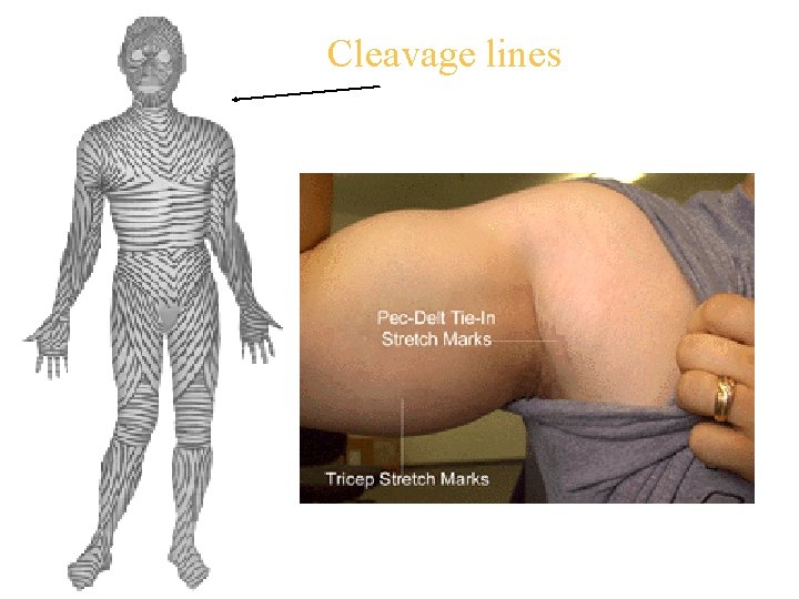 Cleavage lines 