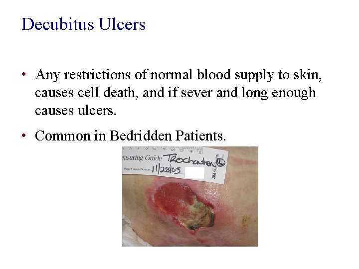 Decubitus Ulcers • Any restrictions of normal blood supply to skin, causes cell death,
