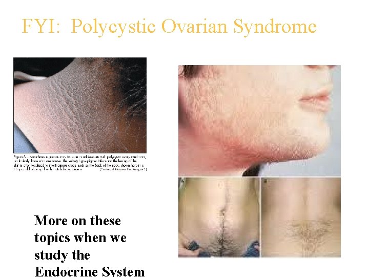 FYI: Polycystic Ovarian Syndrome More on these topics when we study the Endocrine System