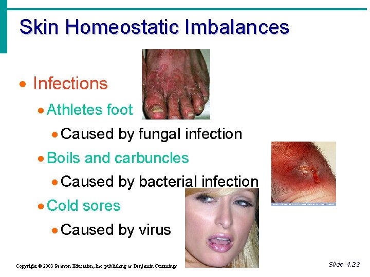 Skin Homeostatic Imbalances · Infections · Athletes foot · Caused by fungal infection ·