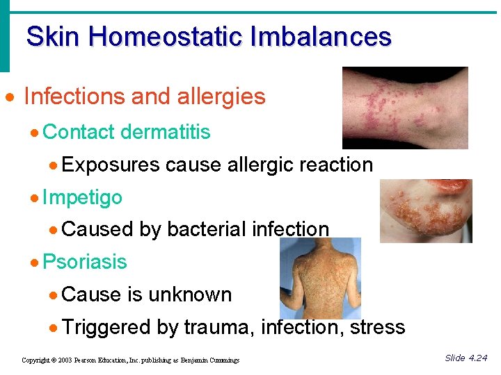 Skin Homeostatic Imbalances · Infections and allergies · Contact dermatitis · Exposures cause allergic