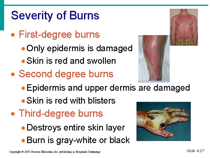 Severity of Burns · First-degree burns · Only epidermis is damaged · Skin is