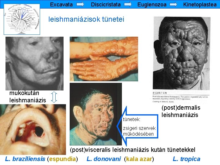 Excavata Discicristata Euglenozoa Kinetoplastea leishmaniázisok tünetei mukokután leishmaniázis tünetek: (post)dermalis leishmaniázis zsigeri szervek működésében