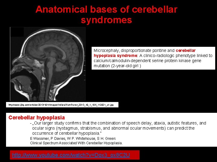 Anatomical bases of cerebellar syndromes Microcephaly, disproportionate pontine and cerebellar hypoplasia syndrome: A clinico-radiologic