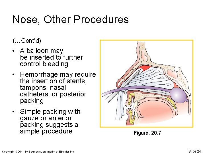 Nose, Other Procedures (…Cont’d) • A balloon may be inserted to further control bleeding