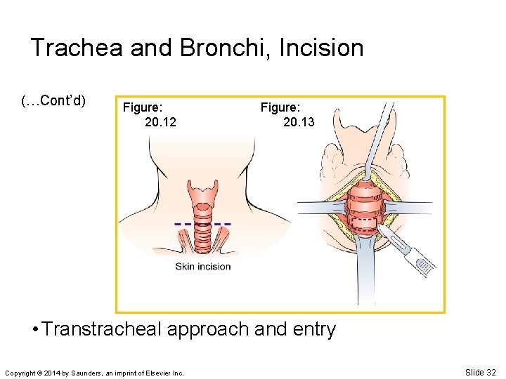 Trachea and Bronchi, Incision (…Cont’d) Figure: 20. 12 Figure: 20. 13 • Transtracheal approach