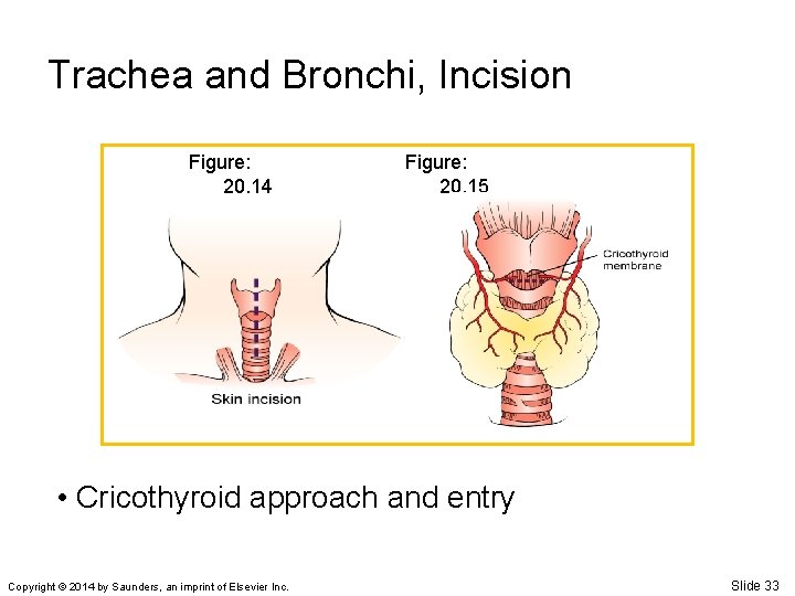 Trachea and Bronchi, Incision Figure: 20. 14 Figure: 20. 15 • Cricothyroid approach and