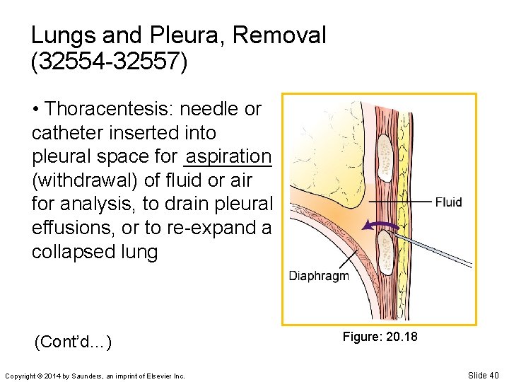 Lungs and Pleura, Removal (32554 -32557) • Thoracentesis: needle or catheter inserted into aspiration