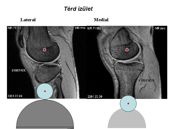 Térd ízület Lateral Medial convex concave 