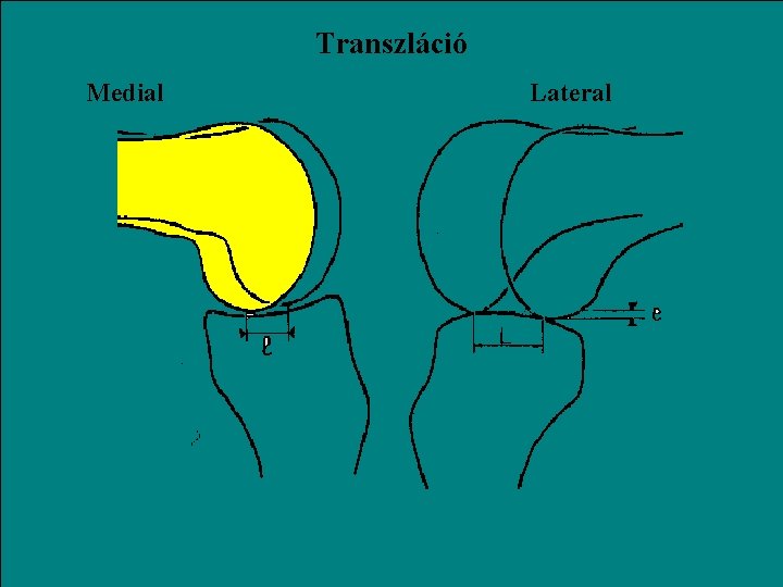 Transzláció Medial Lateral 