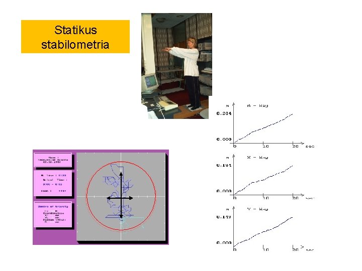 Statikus stabilometria 