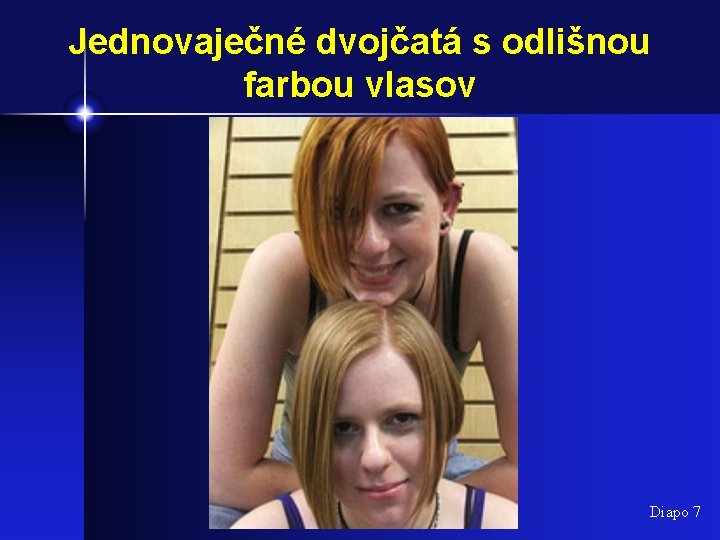 Jednovaječné dvojčatá s odlišnou farbou vlasov Diapo 7 