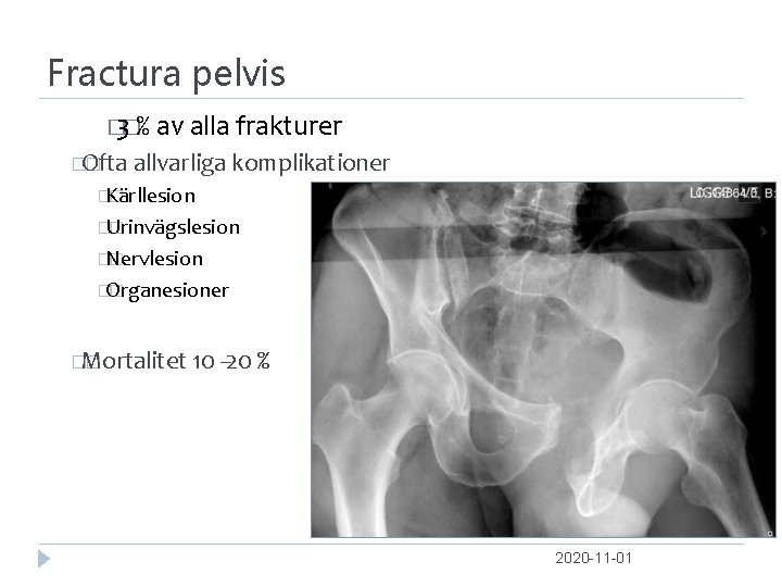 Fractura pelvis � 3�% av alla frakturer �Ofta � allvarliga komplikationer �Kärllesion � �Urinvägslesion