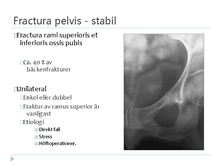 Fractura pelvis - stabil �Fractura � rami superioris et inferioris ossis pubis �Ca. �