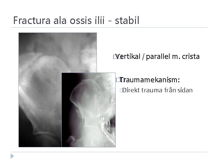 Fractura ala ossis ilii - stabil � Vertikal � / parallel m. crista �Traumamekanism: