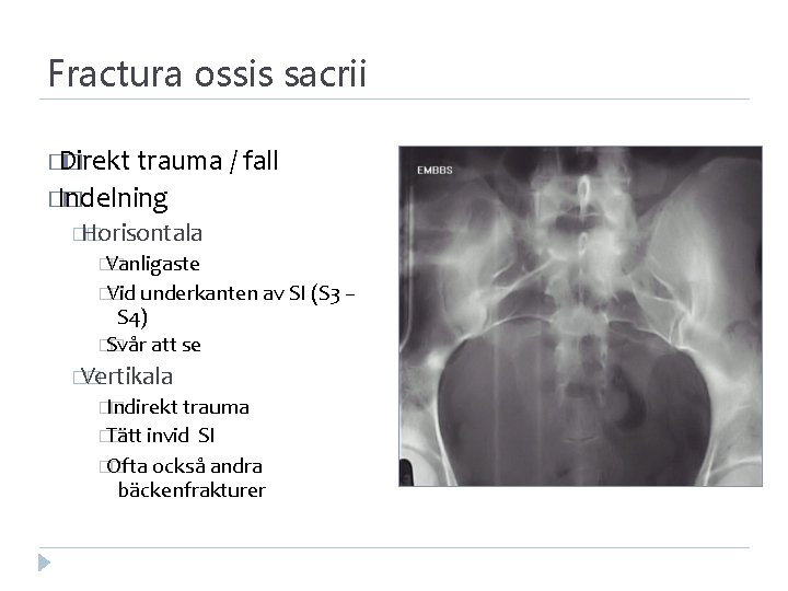 Fractura ossis sacrii � Direkt � trauma / fall � Indelning � �Horisontala �