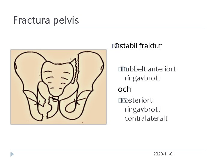 Fractura pelvis � Ostabil � fraktur � Dubbelt � anteriort ringavbrott och � Posteriort