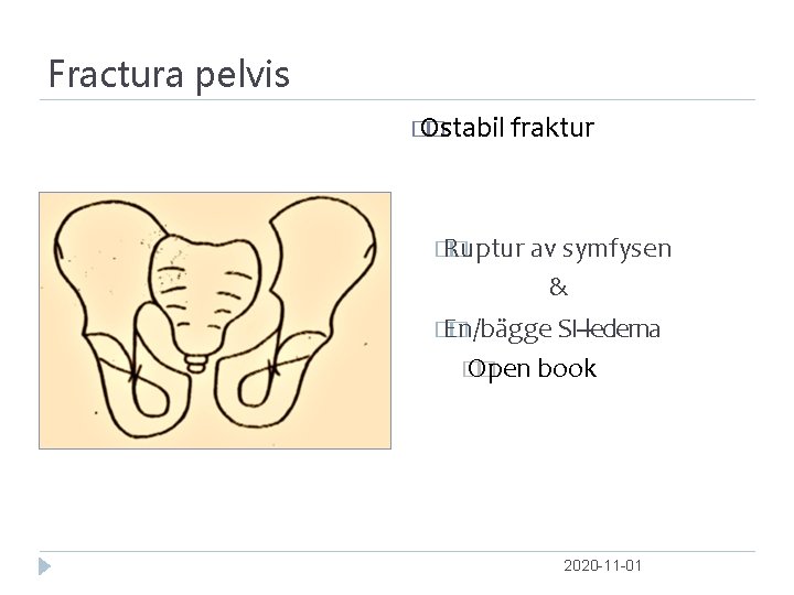 Fractura pelvis � Ostabil � fraktur � Ruptur � av symfysen & � En/bägge