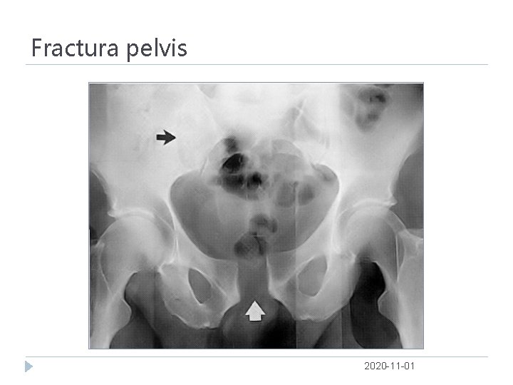 Fractura pelvis 2020 -11 -01 