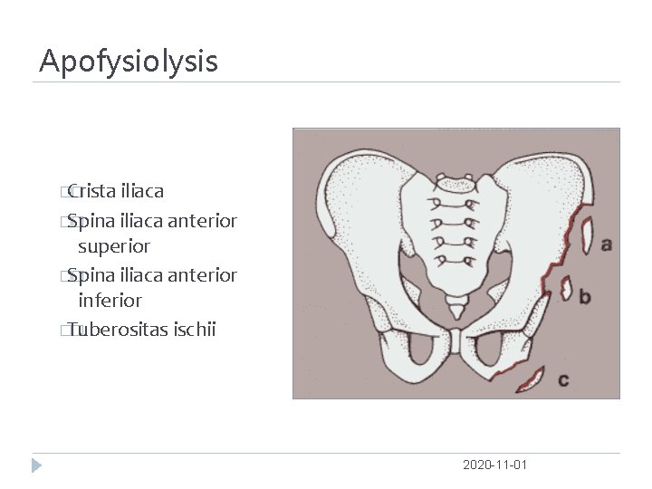 Apofysiolysis �Crista � iliaca �Spina � iliaca anterior superior �Spina � iliaca anterior inferior