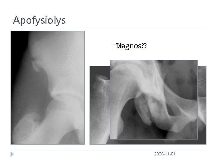 Apofysiolys � Diagnos? ? � 2020 -11 -01 